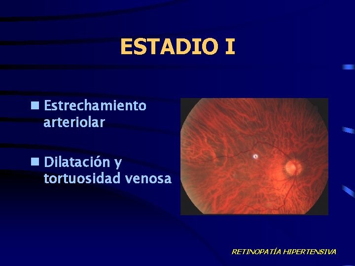 ESTADIO I n Estrechamiento arteriolar n Dilatación y tortuosidad venosa RETINOPATÍA HIPERTENSIVA 