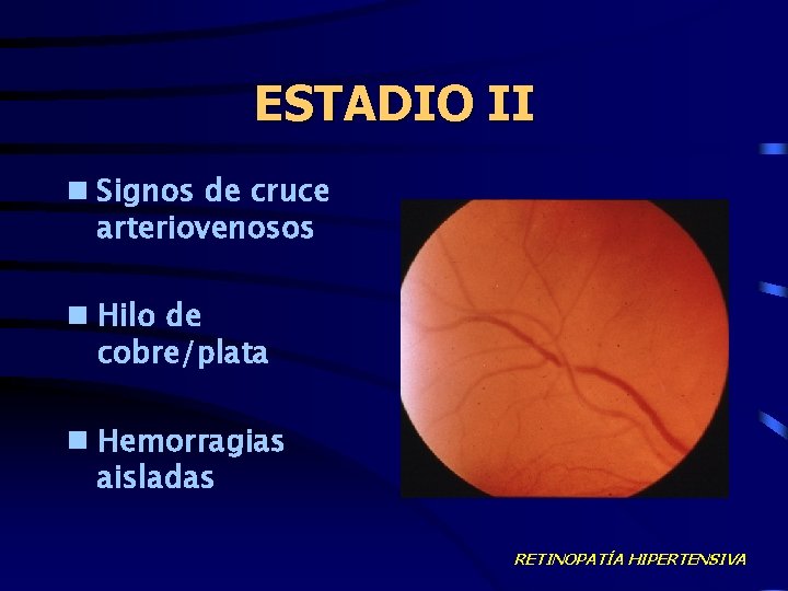 ESTADIO II n Signos de cruce arteriovenosos n Hilo de cobre/plata n Hemorragias aisladas