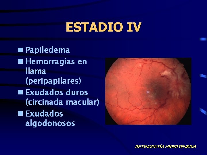 ESTADIO IV n Papiledema n Hemorragias en llama (peripapilares) n Exudados duros (circinada macular)