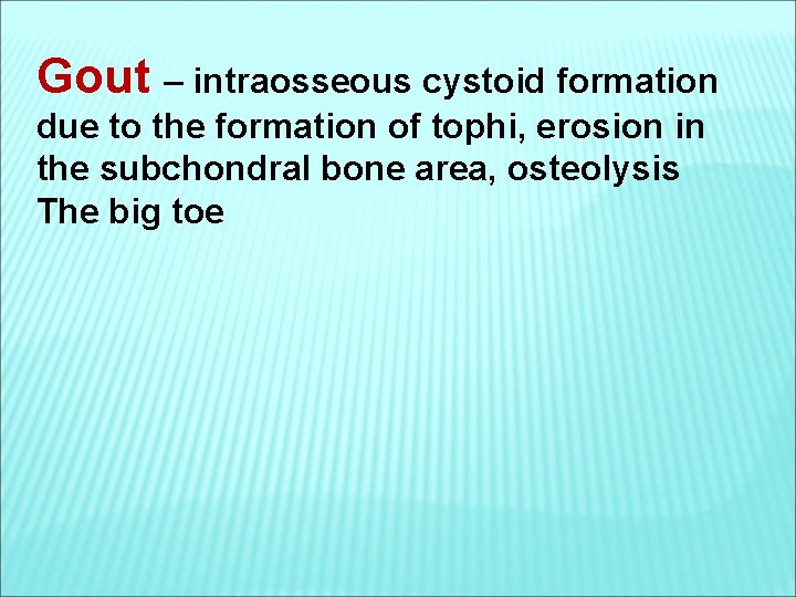 Gout – intraosseous cystoid formation due to the formation of tophi, erosion in the