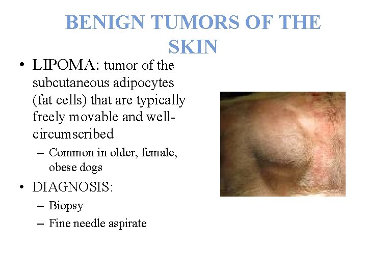 BENIGN TUMORS OF THE SKIN • LIPOMA: tumor of the subcutaneous adipocytes (fat cells)