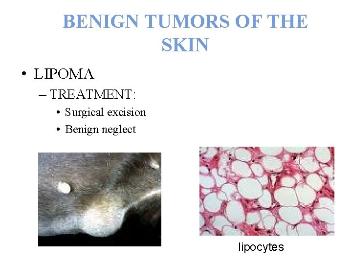 BENIGN TUMORS OF THE SKIN • LIPOMA – TREATMENT: • Surgical excision • Benign
