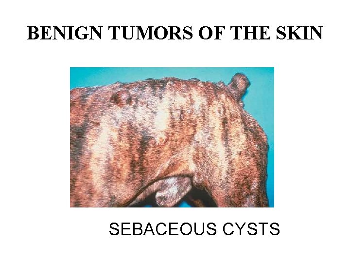 BENIGN TUMORS OF THE SKIN SEBACEOUS CYSTS 