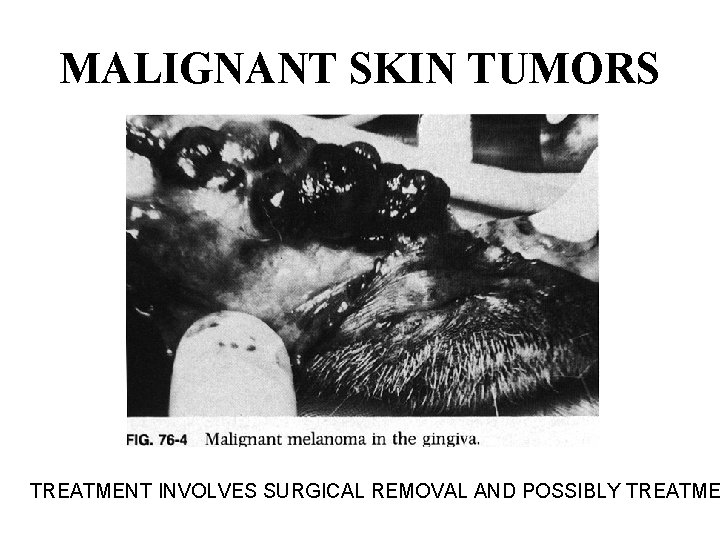 MALIGNANT SKIN TUMORS TREATMENT INVOLVES SURGICAL REMOVAL AND POSSIBLY TREATME 