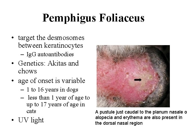 Pemphigus Foliaceus • target the desmosomes between keratinocytes – Ig. G autoantibodies • Genetics: