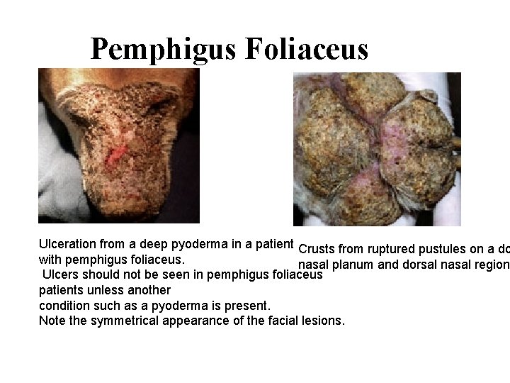 Pemphigus Foliaceus Ulceration from a deep pyoderma in a patient Crusts from ruptured pustules