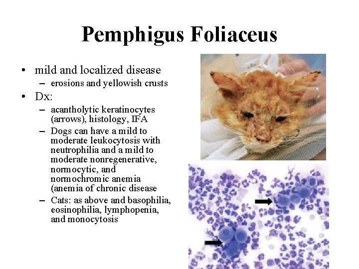 Pemphigus Foliaceus • mild and localized disease – erosions and yellowish crusts • Dx: