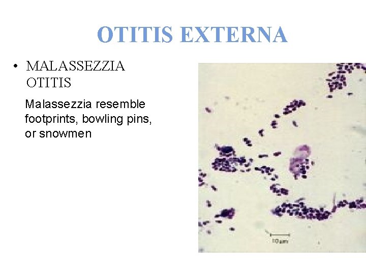 OTITIS EXTERNA • MALASSEZZIA OTITIS Malassezzia resemble footprints, bowling pins, or snowmen 