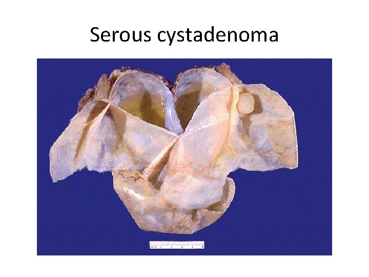 Serous cystadenoma 
