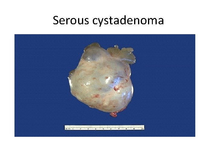 Serous cystadenoma 