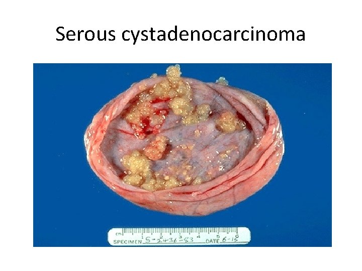 Serous cystadenocarcinoma 