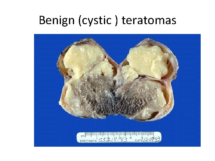 Benign (cystic ) teratomas 