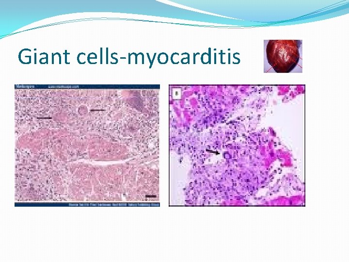 Giant cells-myocarditis 