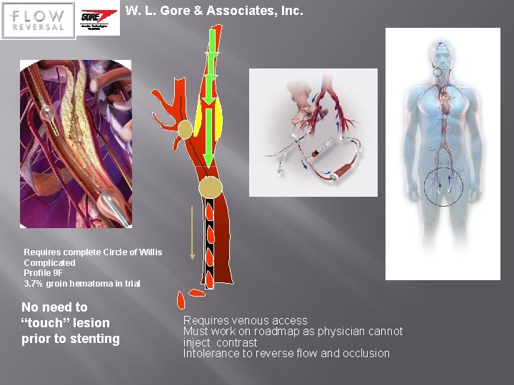 W. L. Gore & Associates, Inc. Requires complete Circle of Willis Complicated Profile 9