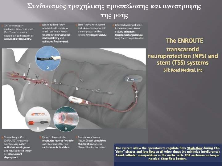 Συνδυασμός τραχηλικής προσπέλασης και αναστροφής της ροής The ENROUTE transcarotid neuroprotection (NPS) and stent