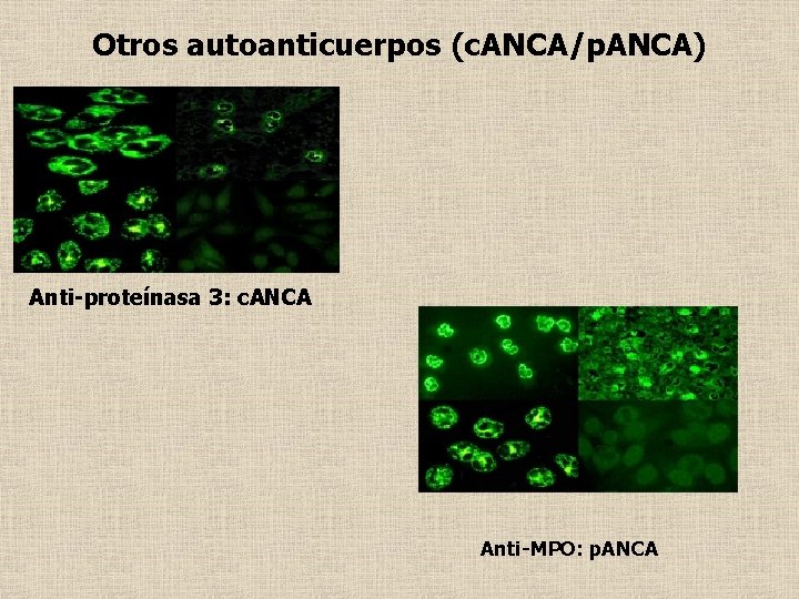 Otros autoanticuerpos (c. ANCA/p. ANCA) Anti-proteínasa 3: c. ANCA Anti-MPO: p. ANCA 