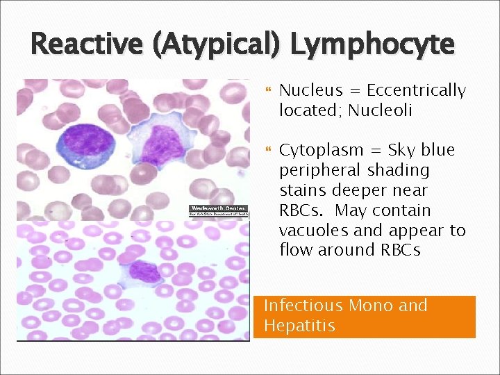 Reactive (Atypical) Lymphocyte Nucleus = Eccentrically located; Nucleoli Cytoplasm = Sky blue peripheral shading