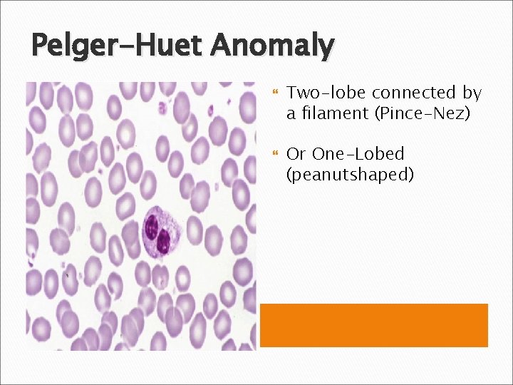 Pelger-Huet Anomaly Two-lobe connected by a filament (Pince-Nez) Or One-Lobed (peanutshaped) 