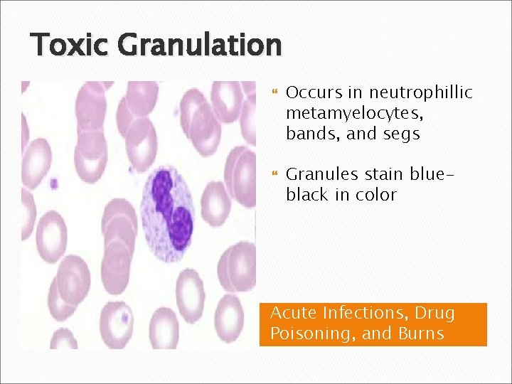 Toxic Granulation Occurs in neutrophillic metamyelocytes, bands, and segs Granules stain blueblack in color