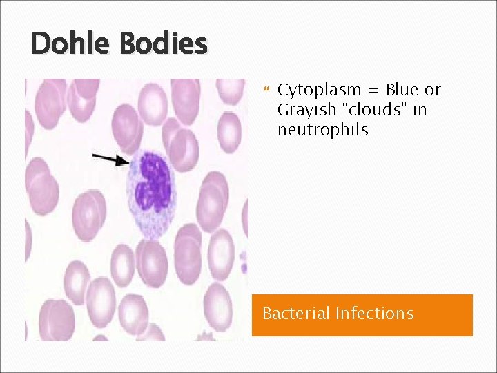 Dohle Bodies Cytoplasm = Blue or Grayish “clouds” in neutrophils Bacterial Infections 