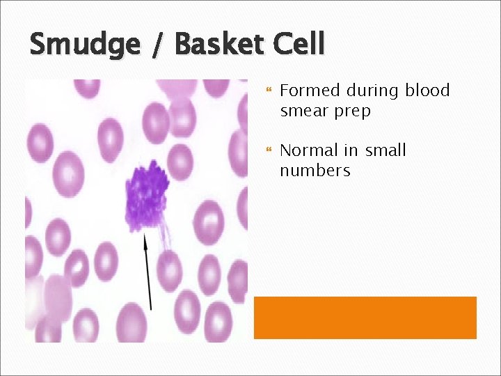 Smudge / Basket Cell Formed during blood smear prep Normal in small numbers 