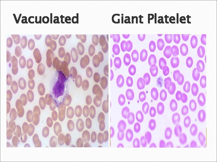 Vacuolated Giant Platelet 