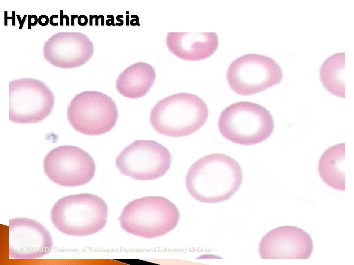 Hypochromasia © 2002 MTS, University of Washington Department of Laboratory Medicine 