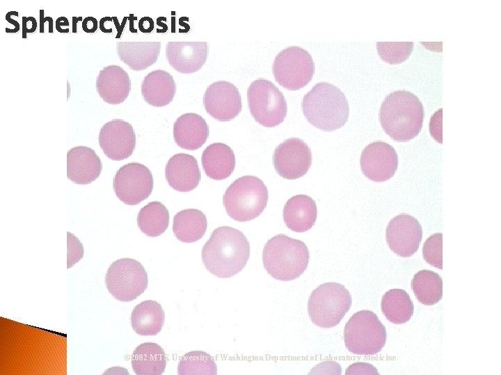 Spherocytosis © 2002 MTS, University of Washington Department of Laboratory Medicine 