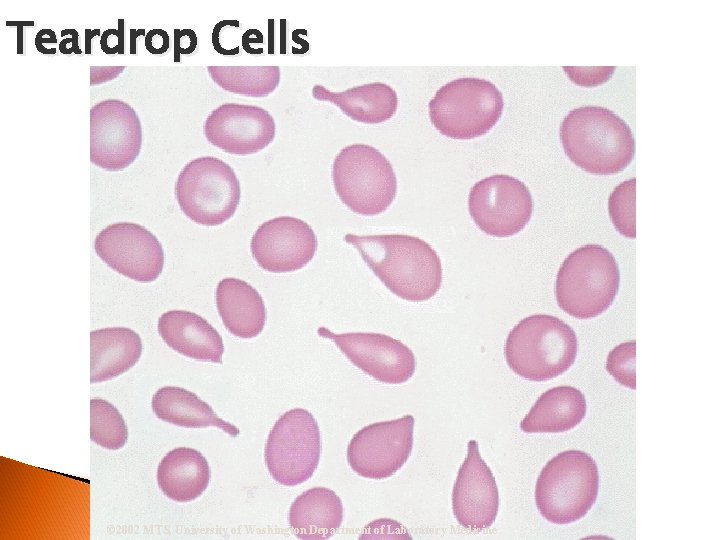 Teardrop Cells © 2002 MTS, University of Washington Department of Laboratory Medicine 