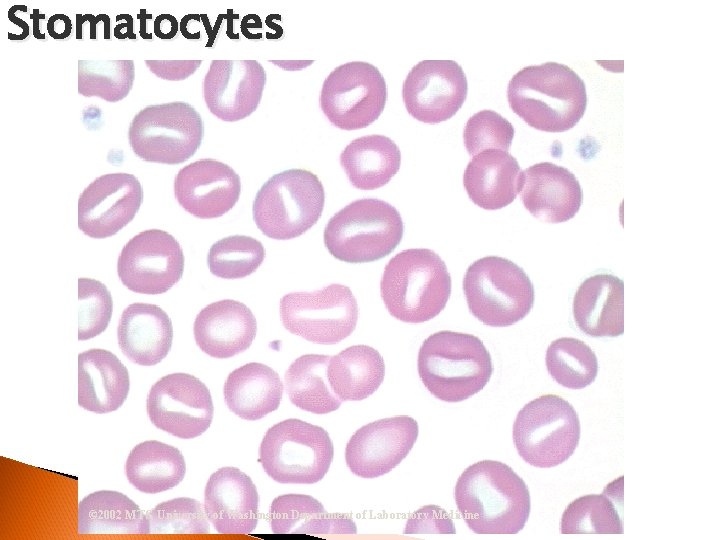 Stomatocytes © 2002 MTS, University of Washington Department of Laboratory Medicine 
