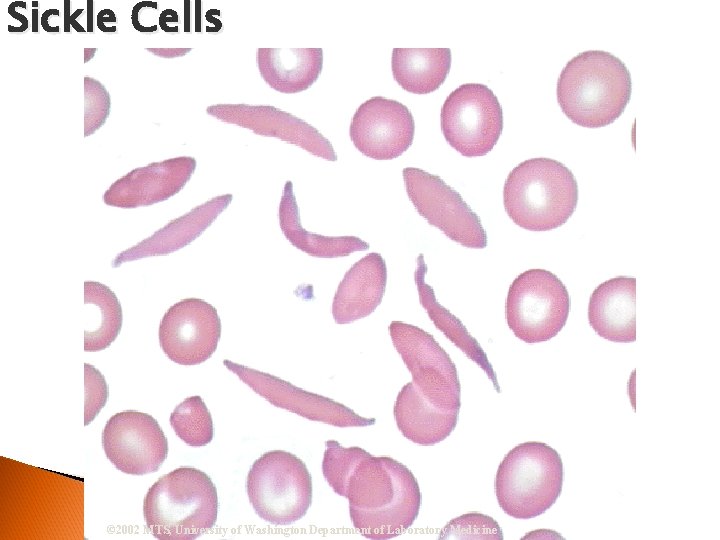 Sickle Cells © 2002 MTS, University of Washington Department of Laboratory Medicine 