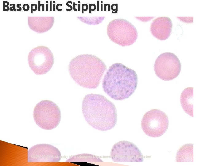 Basophilic Stippling © 2002 MTS, University of Washington Department of Laboratory Medicine 