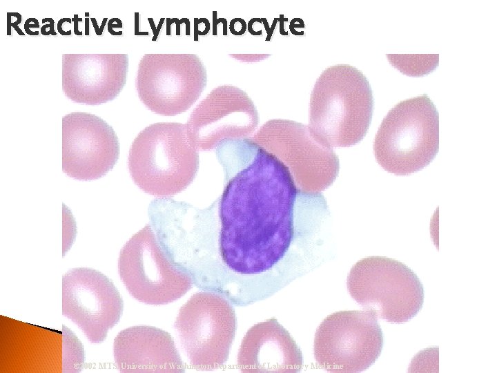 Reactive Lymphocyte © 2002 MTS, University of Washington Department of Laboratory Medicine 