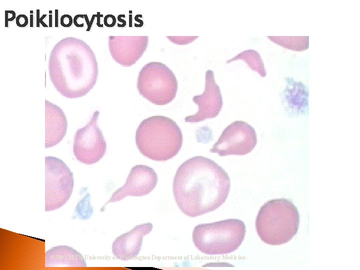 Poikilocytosis © 2002 MTS, University of Washington Department of Laboratory Medicine 