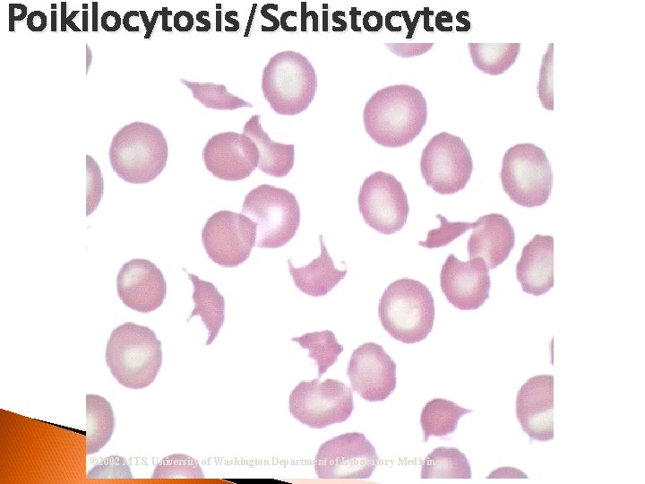 Poikilocytosis/Schistocytes © 2002 MTS, University of Washington Department of Laboratory Medicine 