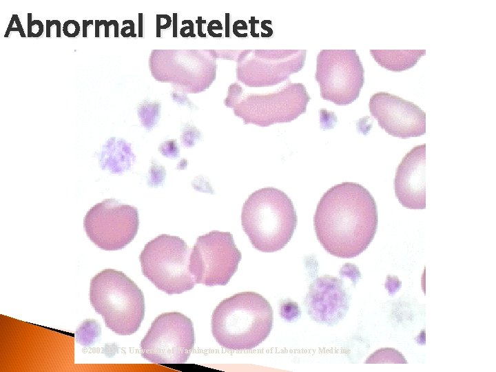 Abnormal Platelets © 2002 MTS, University of Washington Department of Laboratory Medicine 