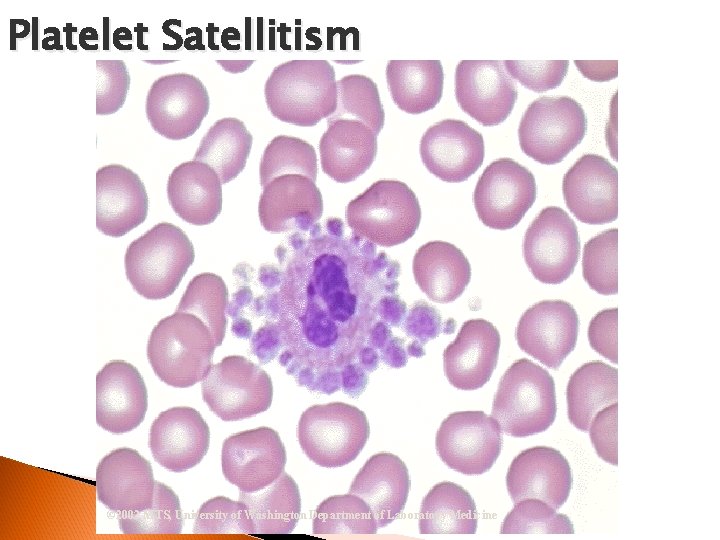 Platelet Satellitism © 2002 MTS, University of Washington Department of Laboratory Medicine 