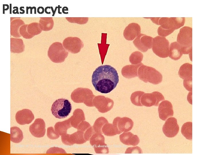 Plasmocyte © 2002 MTS, University of Washington Department of Laboratory Medicine 