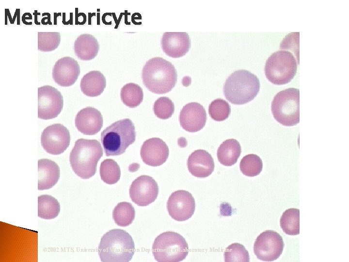 Metarubricyte © 2002 MTS, University of Washington Department of Laboratory Medicine 