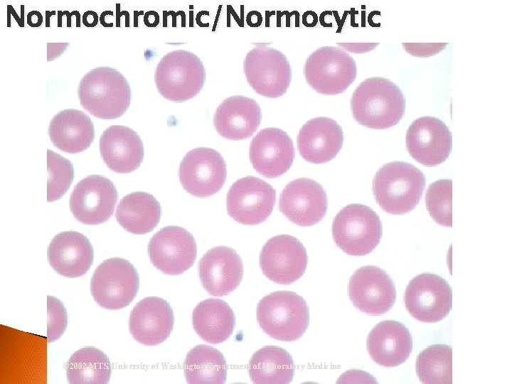 Normochromic/Normocytic © 2002 MTS, University of Washington Department of Laboratory Medicine 