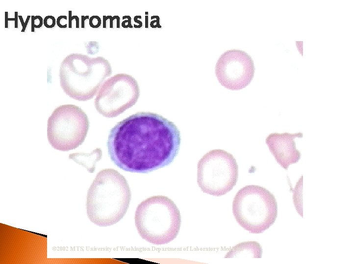 Hypochromasia © 2002 MTS, University of Washington Department of Laboratory Medicine 