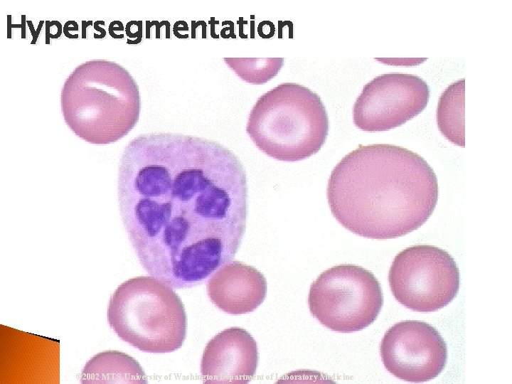 Hypersegmentation © 2002 MTS, University of Washington Department of Laboratory Medicine 