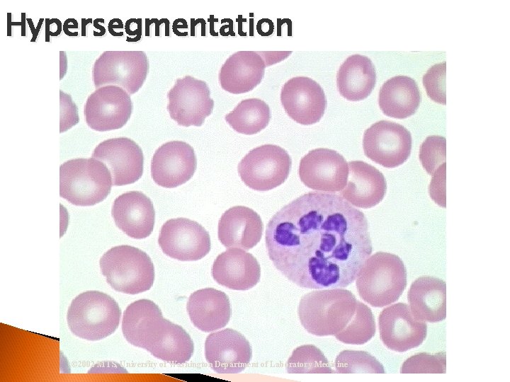 Hypersegmentation © 2002 MTS, University of Washington Department of Laboratory Medicine 