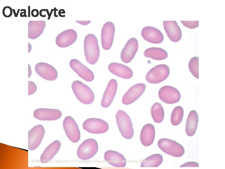 Ovalocyte © 2002 MTS, University of Washington Department of Laboratory Medicine 