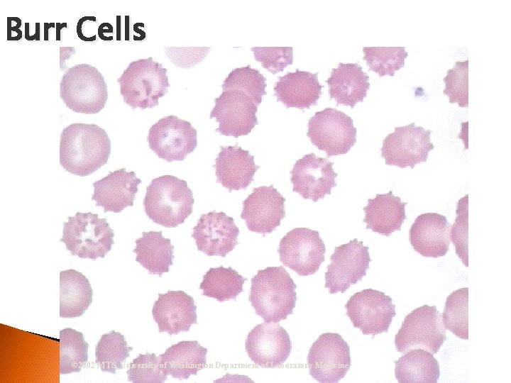 Burr Cells © 2002 MTS, University of Washington Department of Laboratory Medicine 