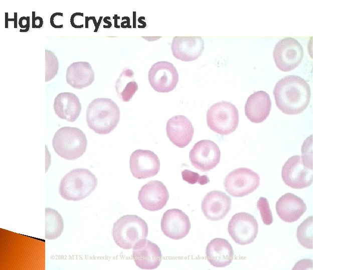 Hgb C Crystals © 2002 MTS, University of Washington Department of Laboratory Medicine 