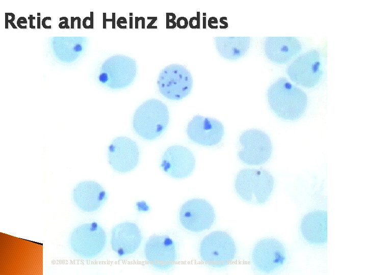 Retic and Heinz Bodies © 2002 MTS, University of Washington Department of Laboratory Medicine