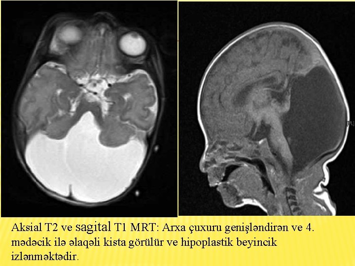 Aksial T 2 ve sagital T 1 MRT: Arxa çuxuru genişləndirən ve 4. mədəcik