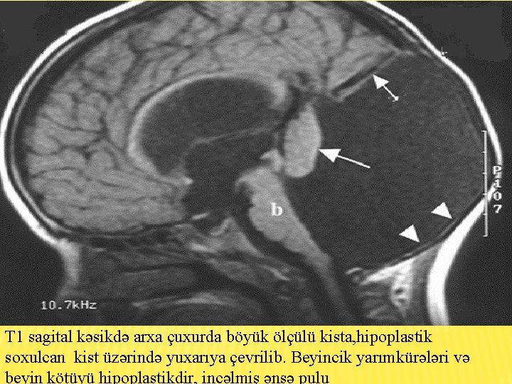 T 1 sagital kəsikdə arxa çuxurda böyük ölçülü kista, hipoplastik soxulcan kist üzərində yuxarıya