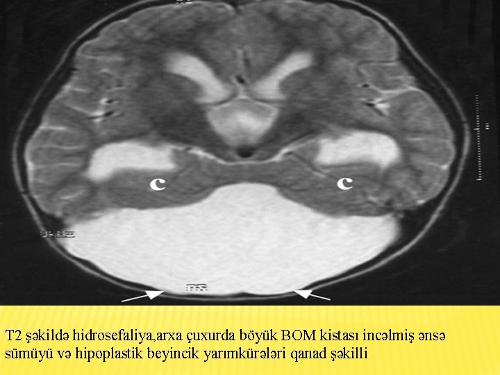 T 2 şəkildə hidrosefaliya, arxa çuxurda böyük BOM kistası incəlmiş ənsə sümüyü və hipoplastik